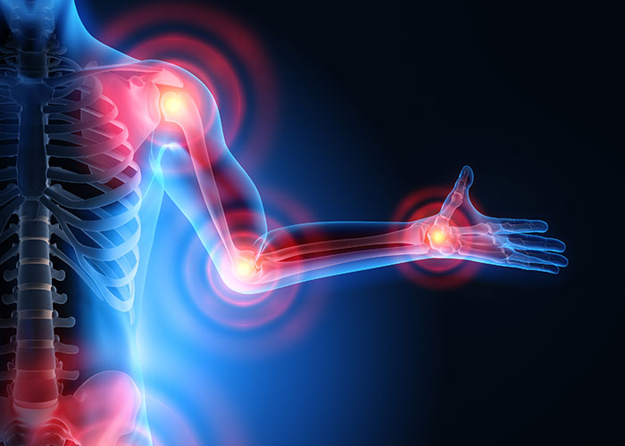 Radiculopathy examples