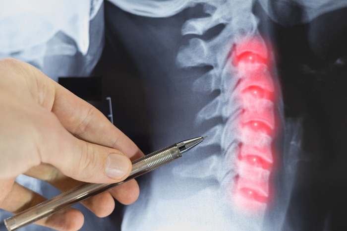 Xray of a patient experiencing whiplash