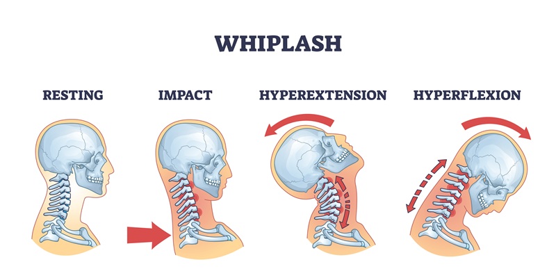 How whiplash happens infographic