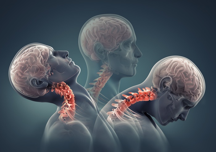 Image demonstrating the effect of whiplash